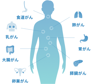 体の中のがんの位置画像